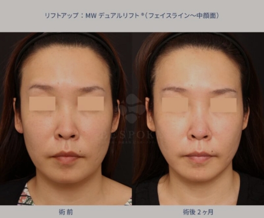 リフトアップ:MWデュアルリフト&reg;（フェイスライン〜中顔面）の画像